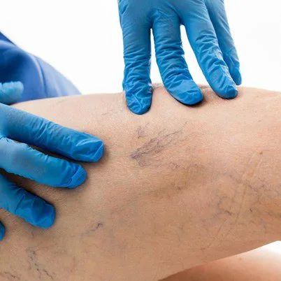b varices tout savoir sur le traitement de cette maladie veineuse 2