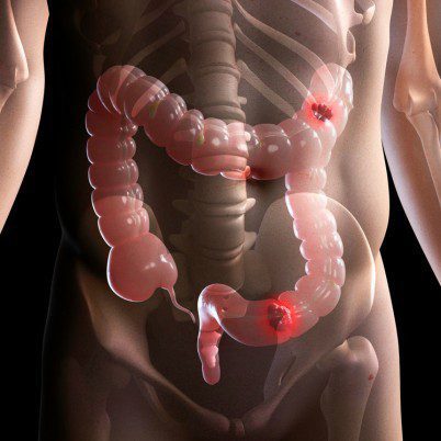 b visuel article maladie de hirschsprung 402